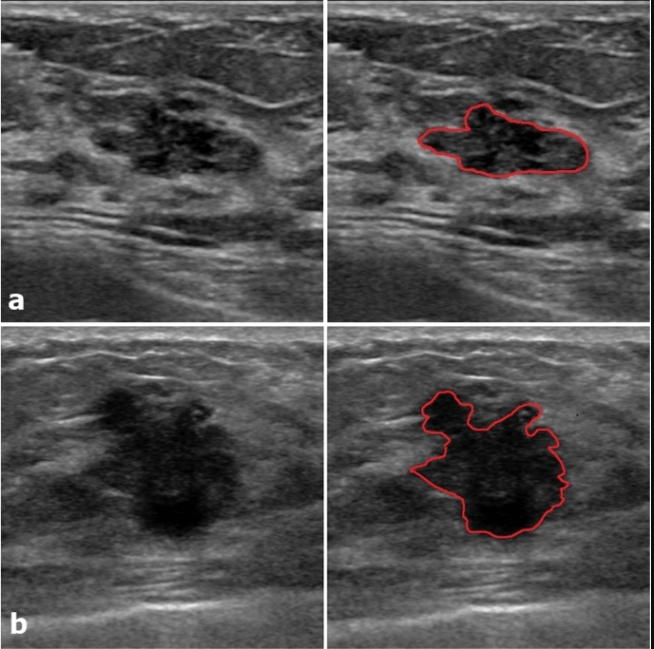 Fibroadenoma Vs Cancer Ultrasound Understanding The Differences