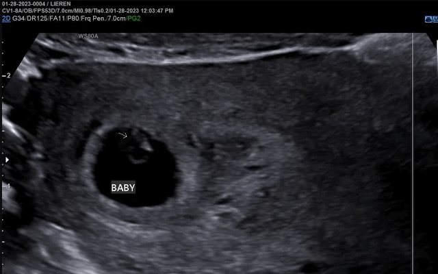 6-weeks-pregnant-ultrasound-what-to-expect-and-why-it-matters